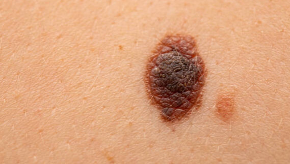 ABCDE czerniaka: jak rozpoznać śmiertelnie niebezpieczną zmianę?
