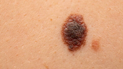 ABCDE czerniaka: jak rozpoznać śmiertelnie niebezpieczną zmianę?