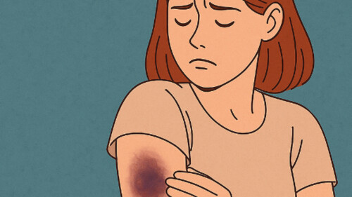 Zespół Gardner-Diamonda: tajemnicze siniaki ze stresu